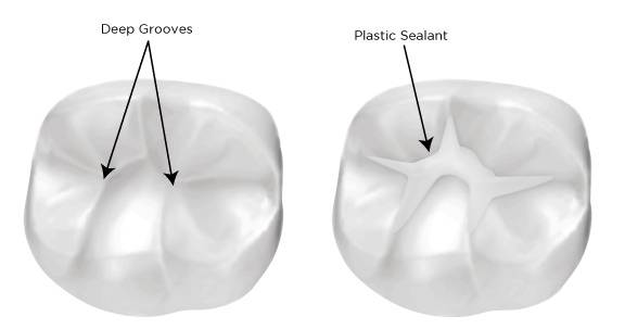 sealants.jpg